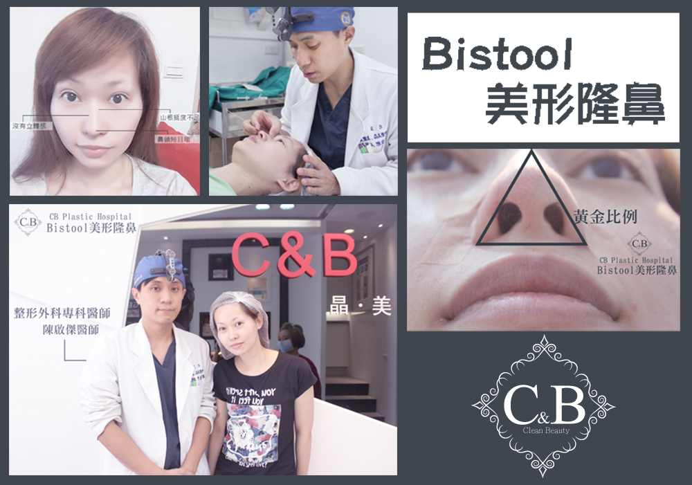 Read more about the article Bistool 美形隆鼻