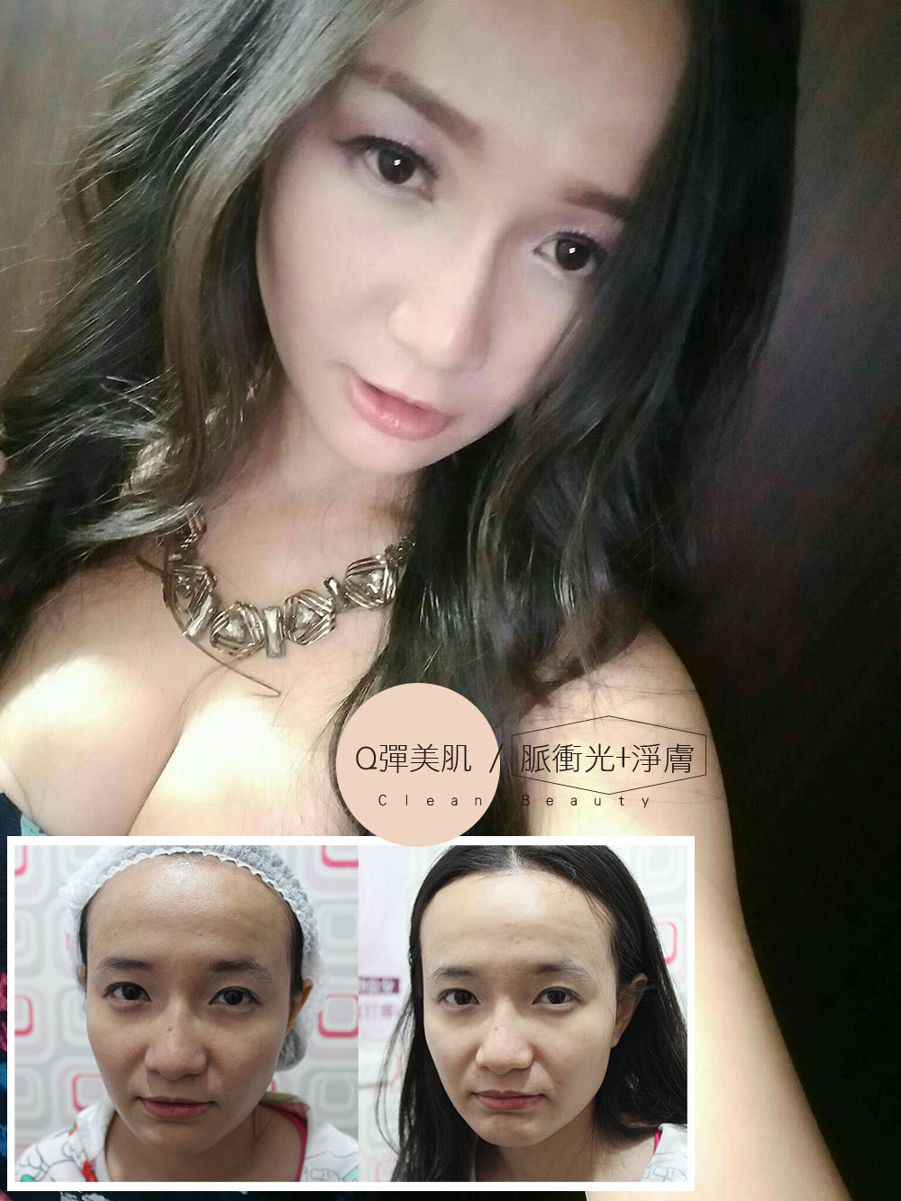 Read more about the article 雞尾酒雷射+午間美容脈衝光美肌好享受