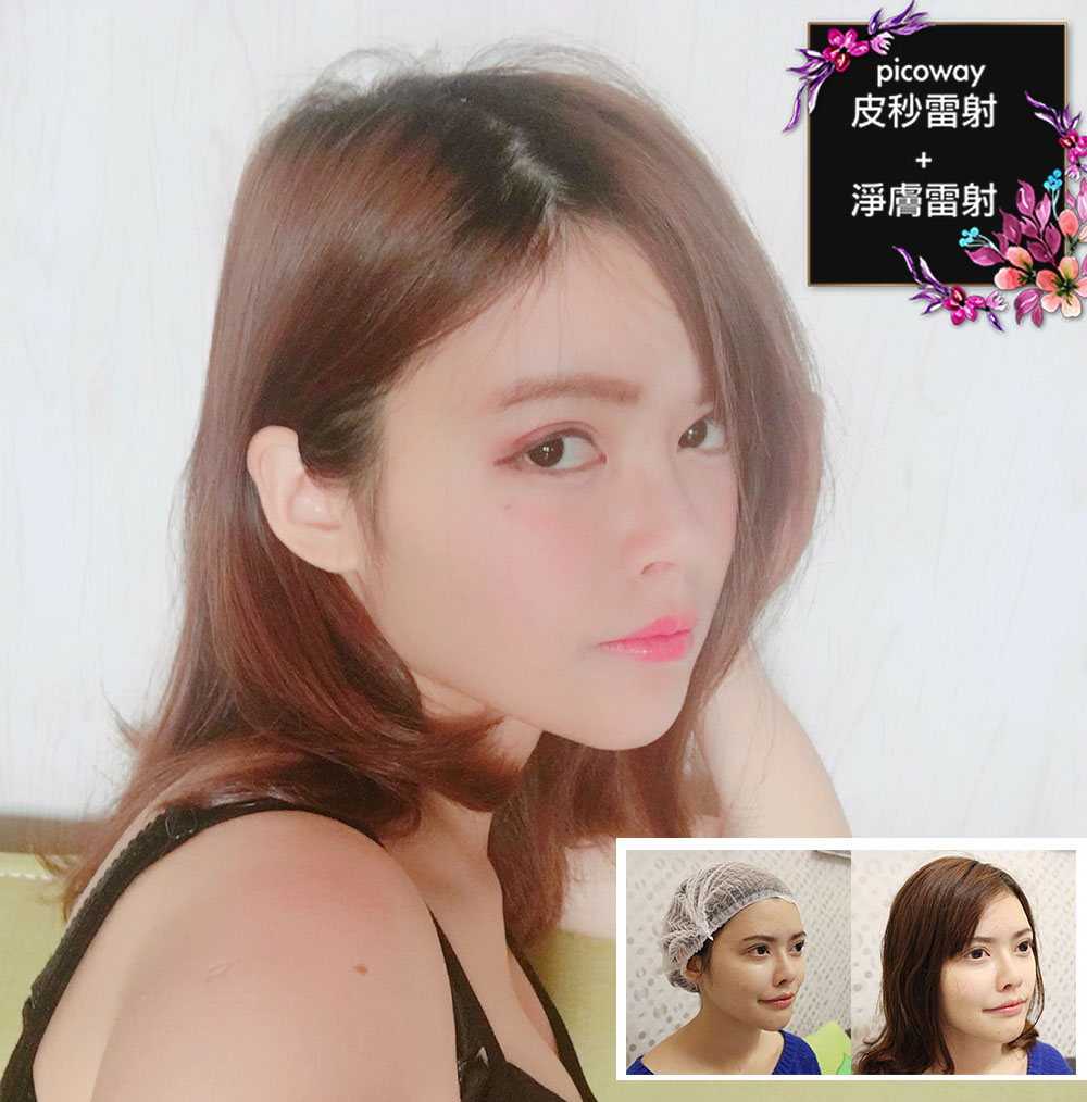 Read more about the article 快速美肌Picoway皮秒雷射美人顏駕到！