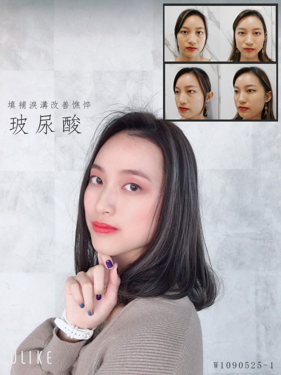 Read more about the article 透過水微晶填補，變的年輕美麗