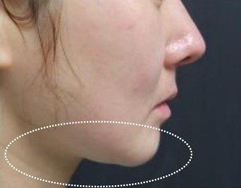 LINE_ALBUM_Liftera2行銷素材_260115_72